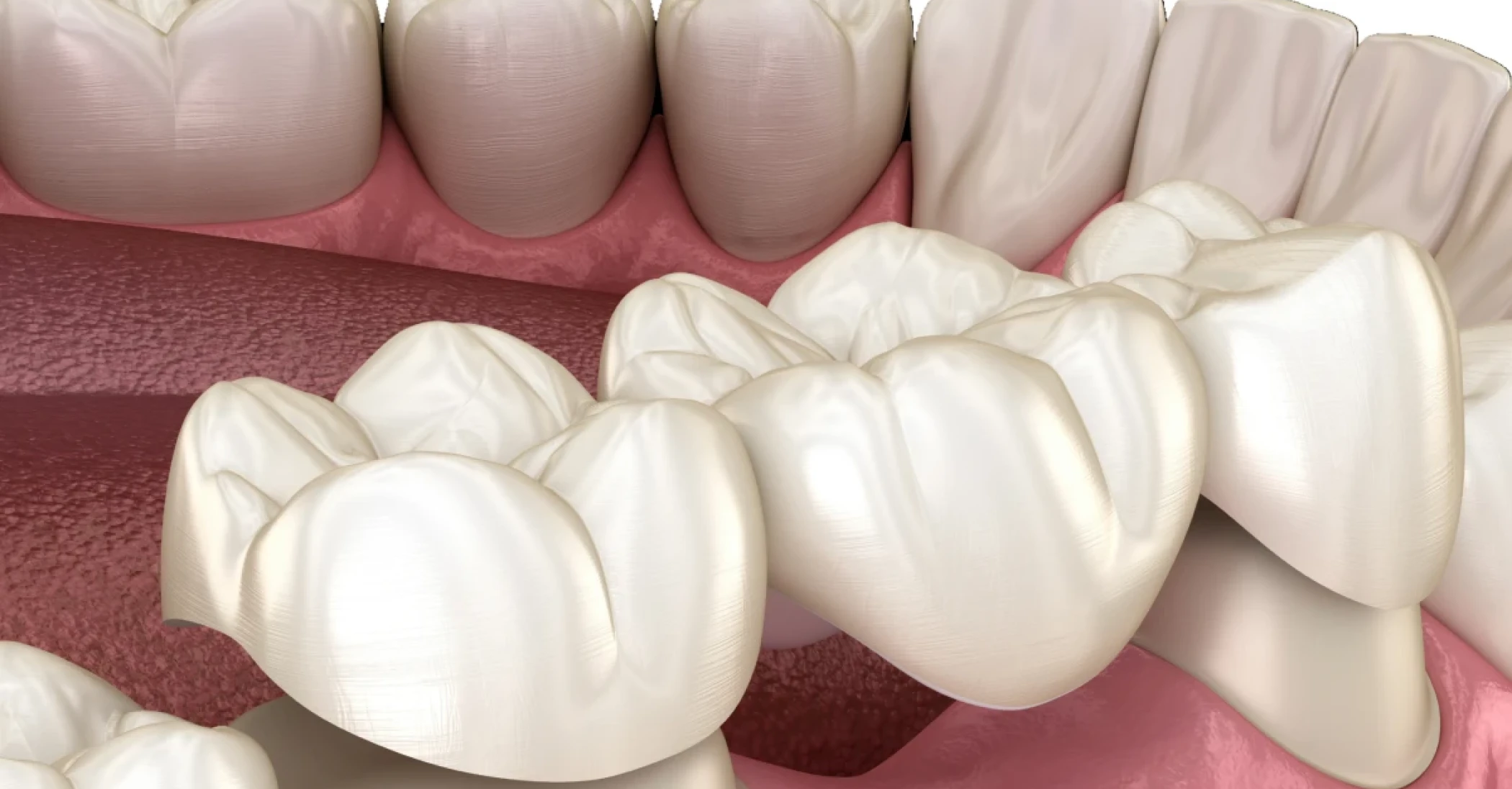 dentiste olivet Bridge