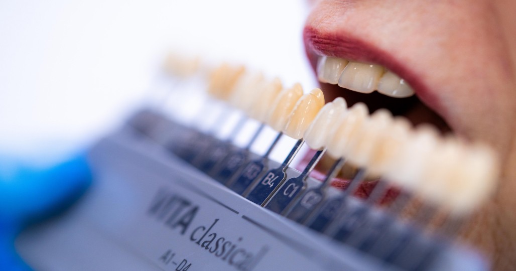 facettes ceramique traitement esthetique Drs Dard Cannet Olivet