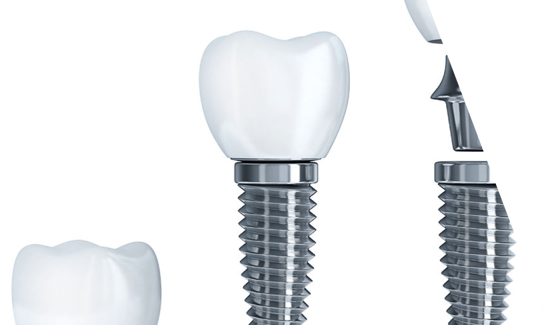 implantologie Drs Dard Cannet chirurgiens dentistes Olivet