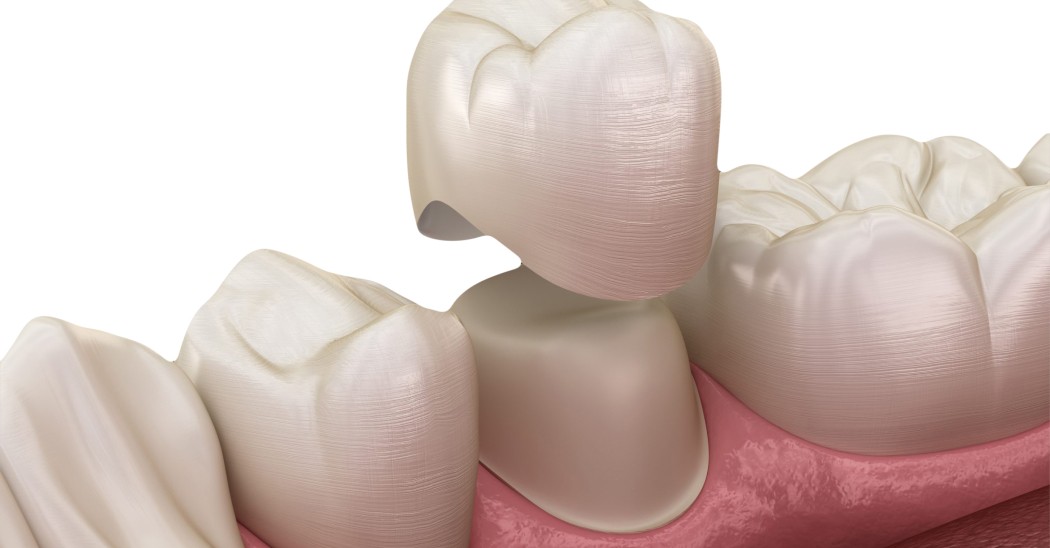 Drs Dard Cannet traitements couronnes dentaires