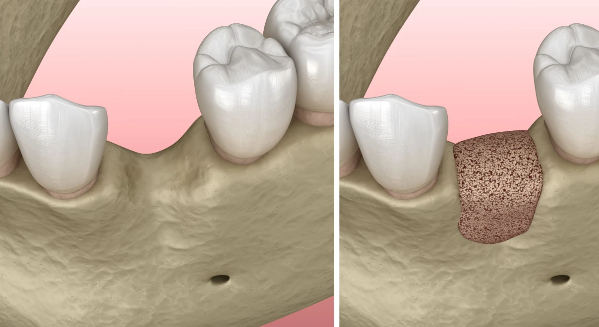 eclaircissement dentaire Régénération osseuse guidée (Greffe osseuse)