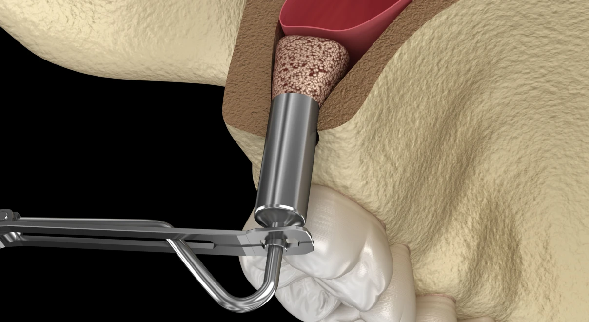 sinus lift dr dard Comblement  osseux sinusien : sinus lift
