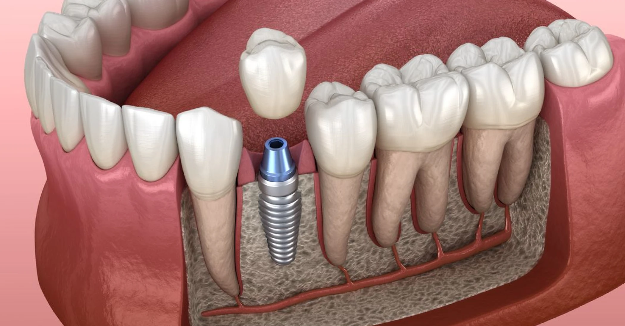 chirurgie muco gingivale dr dard olivet Chirurgie muco-gingivale et péri-implantaire